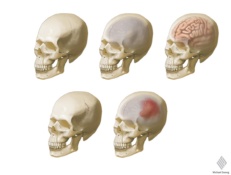 Michael Soong Hematoma 2